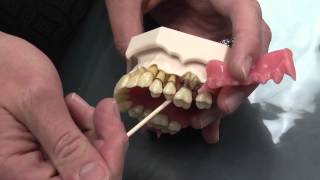 What is Periodontal Disease [upl. by Saxena682]