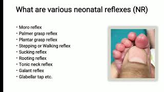 Neonatal Reflex  Plantar Grasp Reflex  Pediatrics [upl. by Dammahum]