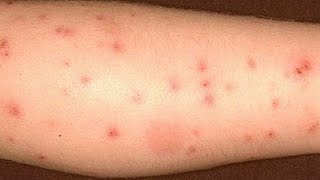 How to get rid of bed bug bites [upl. by Suaeddaht418]