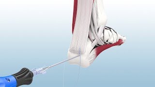 Achilles Tendonitis Pain around the Achilles Tendon Achilles Tendonitis Symptoms amp Treatment [upl. by Aninaj]