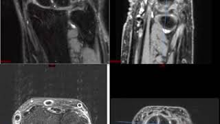 Wrist MRI Approach to MSK MRI Series [upl. by Ijic]