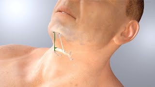 AIRLIFT Hyoid Suspension animation [upl. by Adok885]