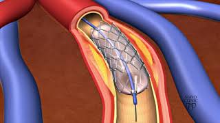 Stents for Opening Blocked Tear Ducts [upl. by Durno868]