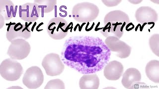 What is quotToxic Granulationquot of Neutrophils Why does it happen Hemepath Hematology Basics [upl. by Matheson]