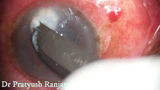 Therapeutic Corneal Ulcer Scraping [upl. by Lull]