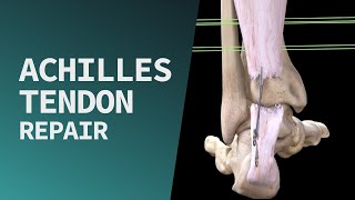 Achilles Tendon Repair [upl. by Erving]