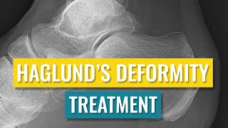 Haglunds Deformity Treatment [upl. by Enahc]