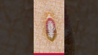 Identifying Bedbug Bites Symptoms and Signs [upl. by Simmonds]