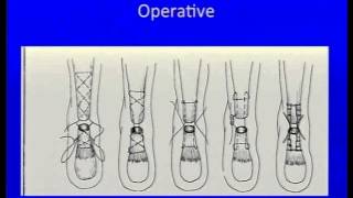 Achilles Tendonitis Treatment with Surgical Debridement Using TenJet Dr Nicholas A Campitelli [upl. by Cosme]