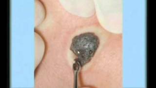 Seborrheic Keratosis Treatment [upl. by Gereld]