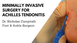 Haglunds Excision and Achilles Reconstruction Using the CuffLink™ System  CONMED Animation [upl. by Desdamona]