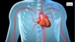 External Iliac Artery Stenting [upl. by Xela]