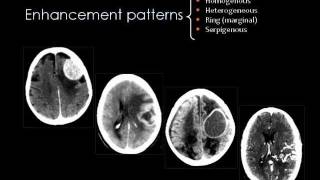 Radiology  Imaging of Brain tumors Part 1 [upl. by Abraham]