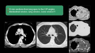 CT Chest Anatomy amp Interpretation Dr Mamdouh Mahfouz [upl. by Alocin]