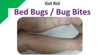 Get Rid Bed Bugs  Bug Bites  Home Remedies for RED and ITCHY Bug BITES [upl. by Htaeh]