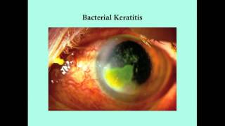 Keratitis  CRASH Medical Review Series [upl. by Aremmat186]